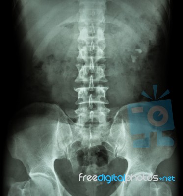 Kidney Stone ( Renal Stone , Renal Calculi ) ( Film X-ray Kub ( Kidney - Ureter - Bladder ) Show Left Renal Stone ) Stock Photo