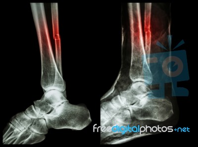 Left Image : Fracture Shaft Of Fibula (calf Bone)  ,  Right Image : It Was Splinted With Plaster Cast Stock Photo