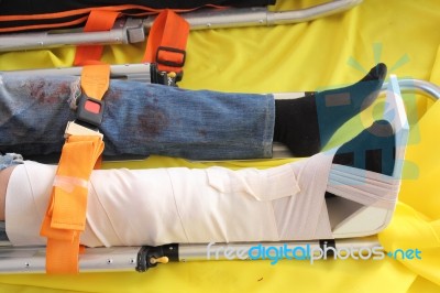 Leg With Splint Stock Photo