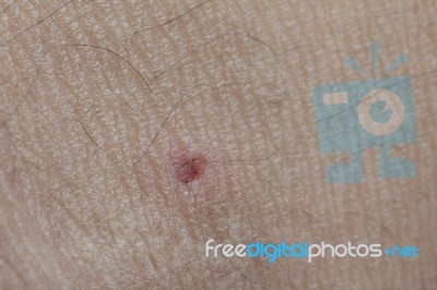 Little Wound From Donation Blood Stock Photo