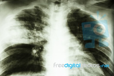 Lobar Pneumonia Stock Photo