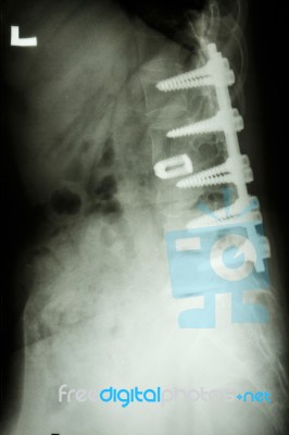 Lumbar Spine With Pedicle Screw Fixation Stock Photo