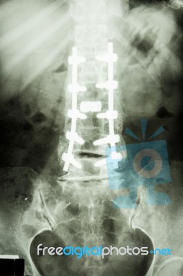 Lumbar Spine With Pedicle Screw Fixation Stock Photo