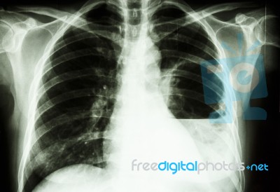 Lung Abscess Stock Photo