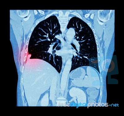 Lung Cancer ( Ct Scan Of Chest And Abdomen : Show Right Lung Cancer ) ( Coronal Plane ) Stock Photo