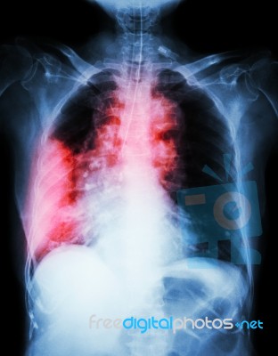 Lung Cancer .  Film Chest X-ray Show Right Lung Mass , Wide Mediastinum , Pneumonia And Right Pleural Effusion Stock Photo