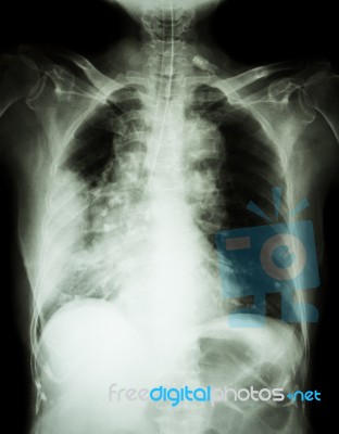 Lung Cancer .  Film Chest X-ray Show Right Lung Mass , Wide Mediastinum , Pneumonia And Right Pleural Effusion Stock Photo