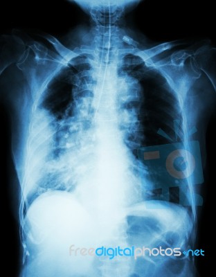 Lung Cancer .  Film Chest X-ray Show Right Lung Mass , Wide Mediastinum , Pneumonia And Right Pleural Effusion Stock Photo