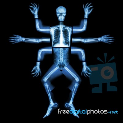 Monster Have Many Arm. (x-ray Whole Body : Head Neck Shoulder Arm Forearm Elbow Wrist Hand Digit Thorax Rib Lung Heart Spine Abdomen Pelvic Hip Thigh Leg Knee Ankle Heel Foot) Stock Photo