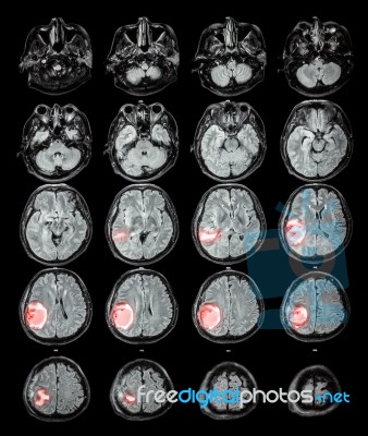 Mri Brain : Brain Tumor At Right Parietal Lobe Stock Photo