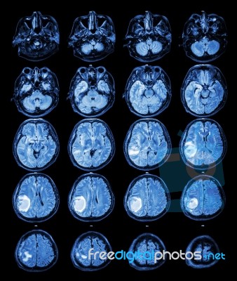 Mri Brain : Brain Tumor At Right Parietal Lobe Stock Photo