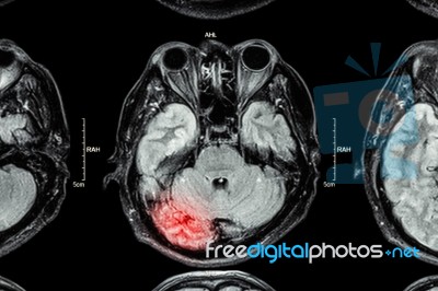 Mri Of Brain : Brain Injury Stock Photo