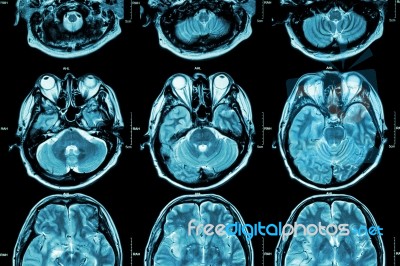 Mri Of Brain ( Cross Section Of Brain ) ( Medical , Health Care , Science Background ) Stock Photo