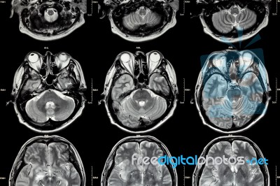 Mri Of Brain ( Cross Section Of Brain ) ( Medical , Health Care , Science Background ) Stock Photo