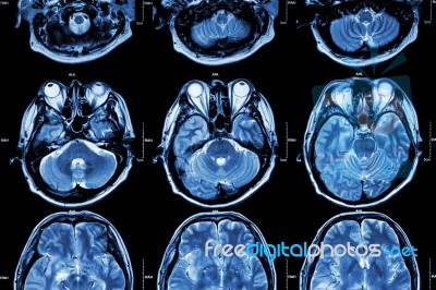 Mri Of Brain ( Cross Section Of Brain ) ( Medical , Health Care , Science Background ) Stock Photo