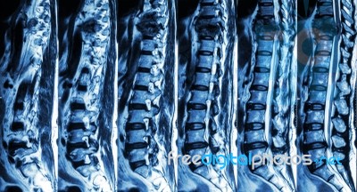 Mri Of Lumbar & Thoracic Spine : Show Fracture Of Thoracic Spine And Compress Spinal Cord ( Myelopathy ) Stock Photo