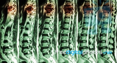 Mri Of Lumbar & Thoracic Spine : Show Fracture Of Thoracic Spine And Compress Spinal Cord ( Myelopathy ) Stock Photo