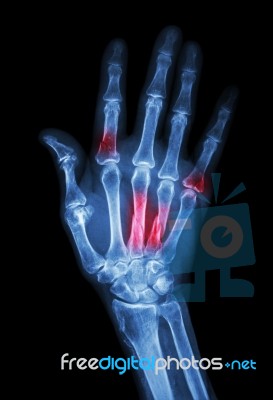 Multiple Fracture At Index,little Finger,metacarpal Bone Stock Photo