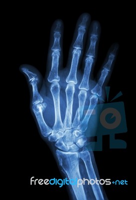 Multiple Fracture At Index,little Finger,metacarpal Bone Stock Photo