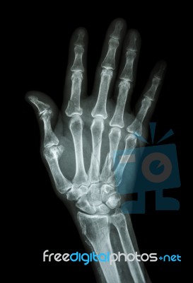 Multiple Fracture At Index,little Finger,metacarpal Bone Stock Photo