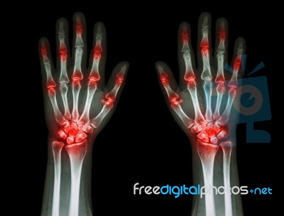 Multiple Joint Arthritis Both Hands ( Gout , Rheumatoid ) On Black Background Stock Photo