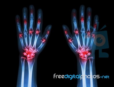 Multiple Joint Arthritis Both Hands ( Gout , Rheumatoid ) On Black Background Stock Photo