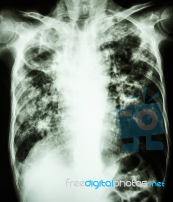 Mycobacterium Tuberculosis Infection (pulmonary Tuberculosis) Stock Photo