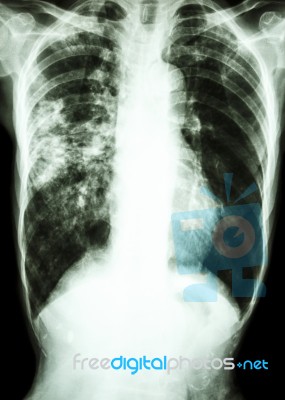 Mycobacterium Tuberculosis Infection (pulmonary Tuberculosis) Stock Photo