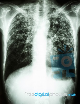 Mycobacterium Tuberculosis Infection (pulmonary Tuberculosis) Stock Photo