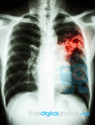 Mycobacterium Tuberculosis Infection (pulmonary Tuberculosis) Stock Photo