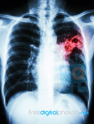 Mycobacterium Tuberculosis Infection (pulmonary Tuberculosis) Stock Photo