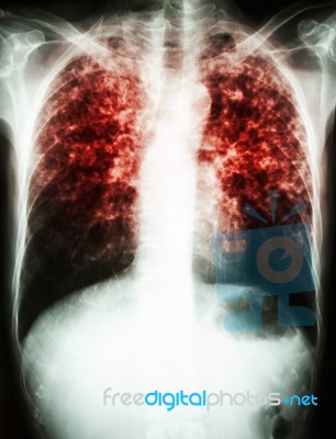 Mycobacterium Tuberculosis Infection (pulmonary Tuberculosis) Stock Photo