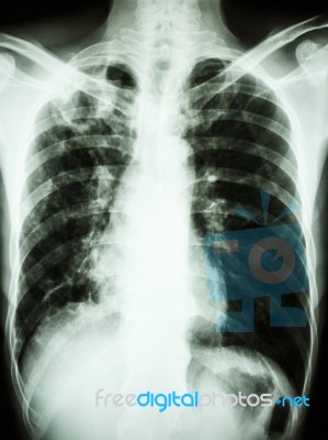 Mycobacterium Tuberculosis Infection (pulmonary Tuberculosis) Stock Photo