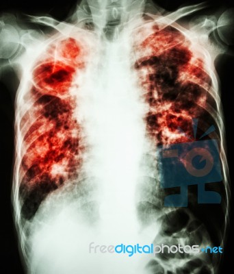 Mycobacterium Tuberculosis Infection (pulmonary Tuberculosis) Stock Photo