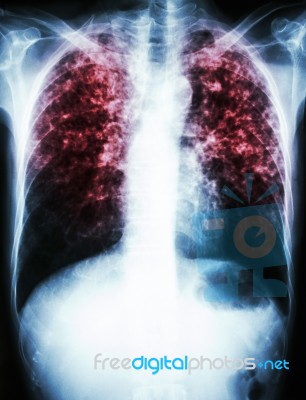 Mycobacterium Tuberculosis Infection (pulmonary Tuberculosis) Stock Photo