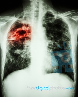 Mycobacterium Tuberculosis Infection (pulmonary Tuberculosis) Stock Photo