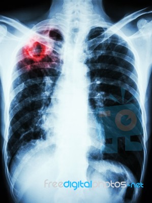 Mycobacterium Tuberculosis Infection (pulmonary Tuberculosis) Stock Photo