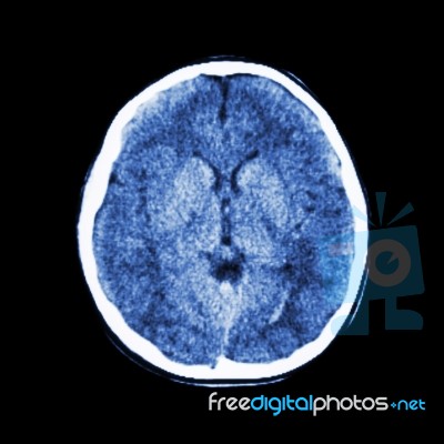 Normal Ct Scan Of Brain (computed Tomography) Stock Photo