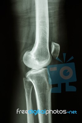 Normal Human's Knee Joint Stock Photo