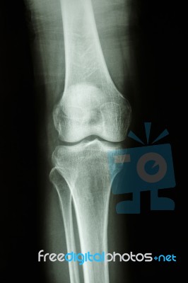 Normal Human's Knee Joint Stock Photo