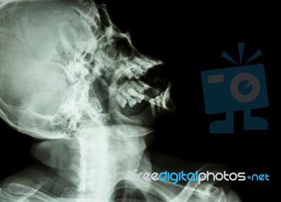 Normal Human's Skull Stock Photo