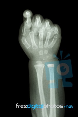 Normal Infant's Hand Bone Stock Photo