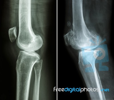 Normal Knee ( Left Image ) And Osteoarthritis Knee ( Right Image ) ( Lateral View ) Stock Photo