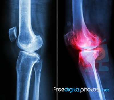 Normal Knee ( Left Image ) And Osteoarthritis Knee ( Right Image ) ( Lateral View ) Stock Photo