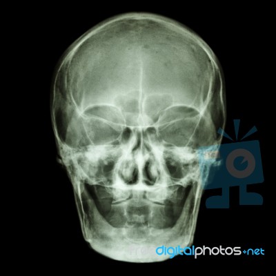 Normal Old Aged Asian Skull (thai People),(no Tooth) Stock Photo