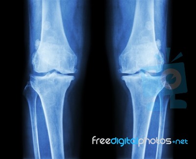 Osteoarthritis Both Knee .  Film X-ray Ap ( Anterior - Posterior ) Of Knee Show Narrow Joint Space , Osteophyte ( Spur ) , Subcondral Sclerosis Stock Photo