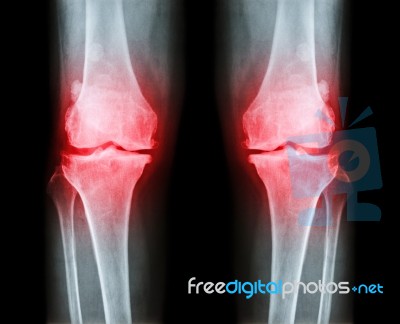 Osteoarthritis Both Knee .  Film X-ray Ap ( Anterior - Posterior ) Of Knee Show Narrow Joint Space , Osteophyte ( Spur ) , Subcondral Sclerosis Stock Photo