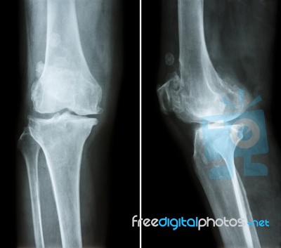 Osteoarthritis Knee .  Film X-ray Knee ( Anterior - Posterior And Lateral View )  Show Narrow Joint Space , Osteophyte ( Spur ) , Subcondral Sclerosis Due To Degenerative Change Stock Photo