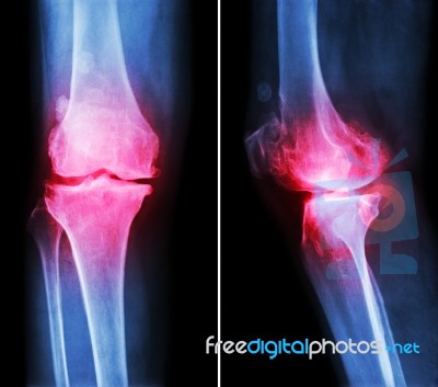 Osteoarthritis Knee .  Film X-ray Knee ( Anterior - Posterior And Lateral View )  Show Narrow Joint Space , Osteophyte ( Spur ) , Subcondral Sclerosis Due To Degenerative Change Stock Photo