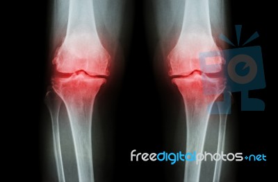 Osteoarthritis Knee ( Oa Knee ). Film X-ray Both Knee ( Front View ) Show Narrow Joint Space ( Joint Cartilage Loss ) , Osteophyte , Subchondral Sclerosis Stock Photo